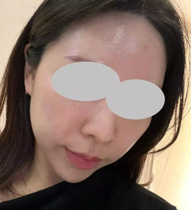 [네이버 스마트스토어 리뷰] 이젠 생리전에 뾰루지 올라오는거 말고는 거의 여드름 안나요 ㅎㅎㅎ2-4번 10분씩 해요