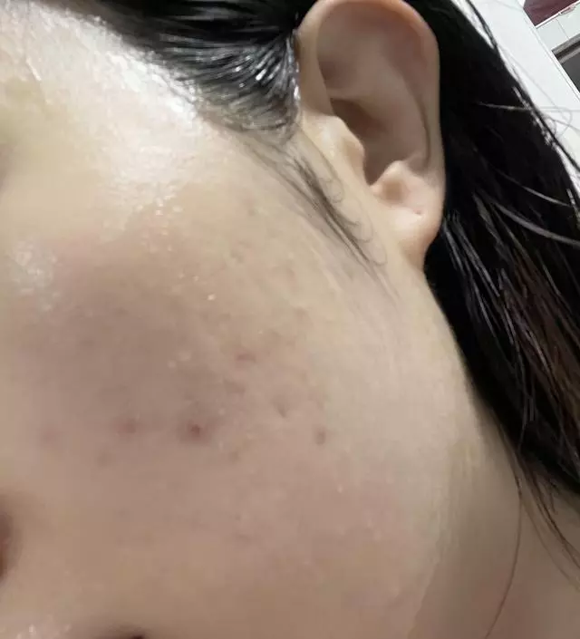 [네이버 스마트스토어 리뷰] 성인여드름피부입니다. 날씨가 급변하거나 생리시즌에 여드름 우루루 나고 그걸 수습하