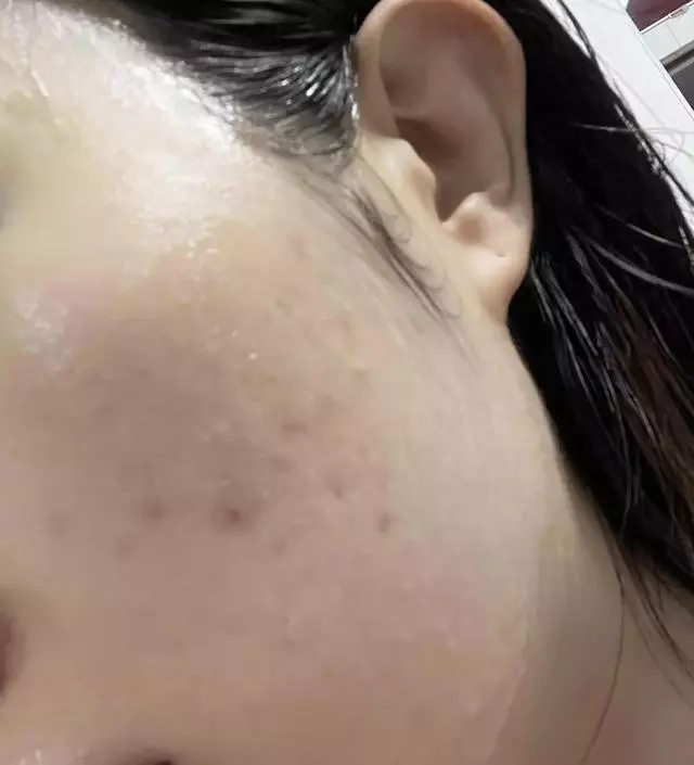 [네이버 스마트스토어 리뷰] 성인여드름피부입니다. 날씨가 급변하거나 생리시즌에 여드름 우루루 나고 그걸 수습하