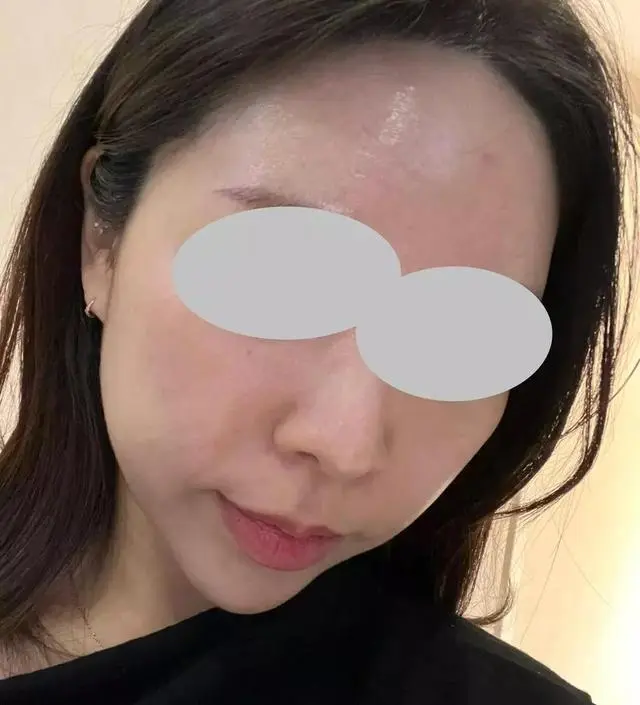 [네이버 스마트스토어 리뷰] 이젠 생리전에 뾰루지 올라오는거 말고는 거의 여드름 안나요 ㅎㅎㅎ2-4번 10분씩 해요