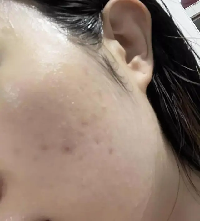 [네이버 스마트스토어 리뷰] 성인여드름피부입니다. 날씨가 급변하거나 생리시즌에 여드름 우루루 나고 그걸 수습하