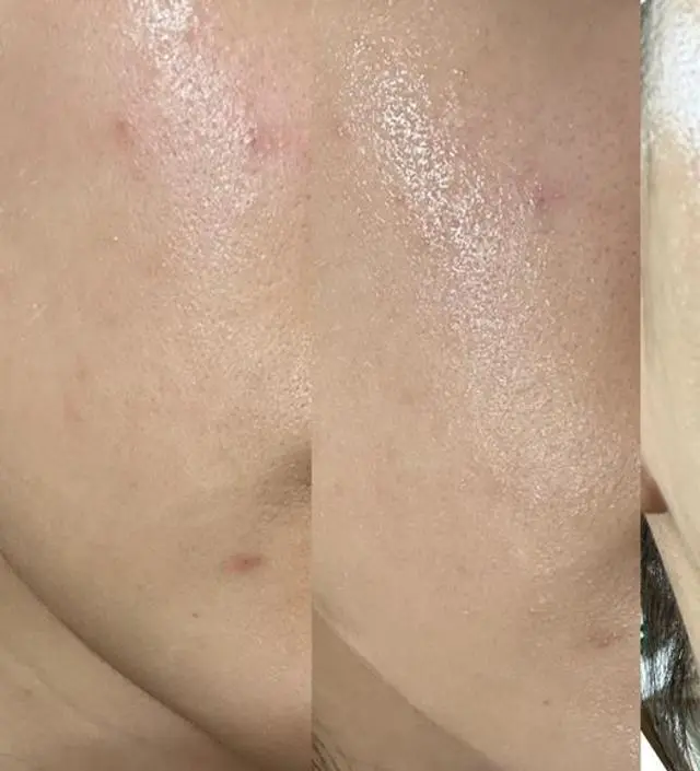 피부가 점점 좋아지고 있어서 후기 남기러 들어왔어요