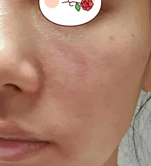 [네이버 스마트스토어 리뷰] 레티놀 과사용으로 얼굴이 화상당한듯 뜨겁고 붉게 발적이 일어나고 각질이 벗겨지고 너