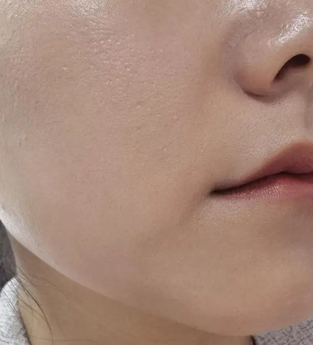 2주 동안 매일 사용한 후기. 1) 민감한 피부 진정효과가 있다. 얼굴 솜털 레이저 1회차