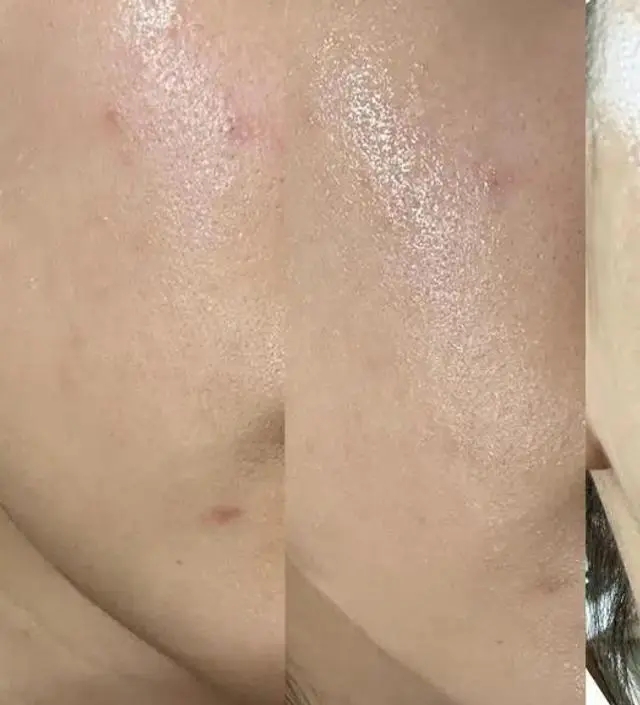 피부가 점점 좋아지고 있어서 후기 남기러 들어왔어요
