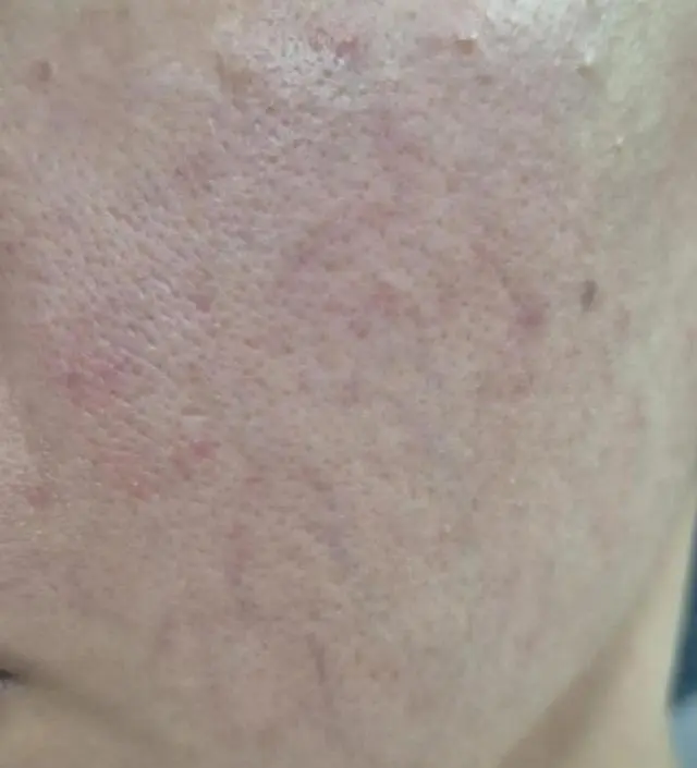 피부가 워낙 안좋아서 확 차이나지 않아보이겠지만,
