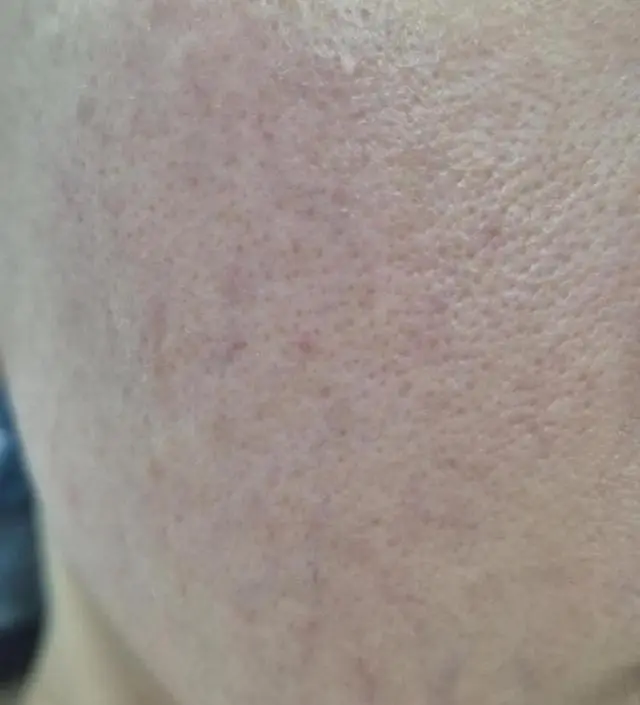 피부가 워낙 안좋아서 확 차이나지 않아보이겠지만,
