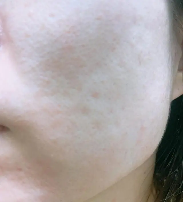 코랑 턱부분 자주 보이던 블랙헤드랑 화이트헤드가 점차 옅어지고 깔끔히 제거되는게 육
