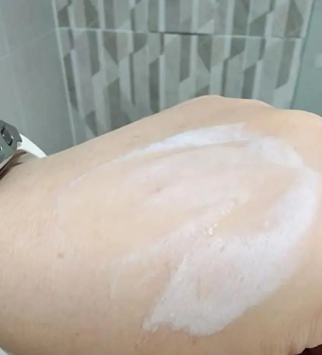 블랙헤드 뿐만 아니라 화이트헤드
