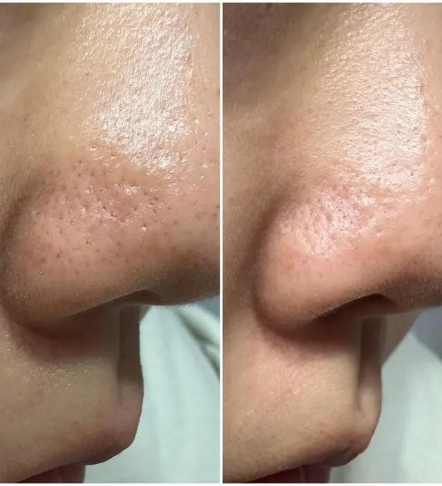 항상 블랙헤드 관리는 짜는거나 녹여서 긁어내는것만 쓰다가 광고보고 구매했습니다. 물