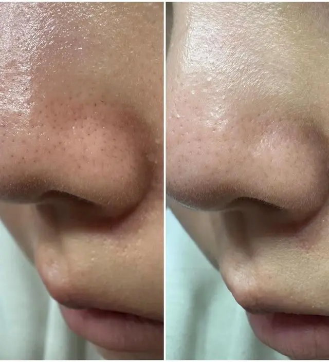 항상 블랙헤드 관리는 짜는거나 녹여서 긁어내는것만 쓰다가 광고보고 구매했습니다. 물