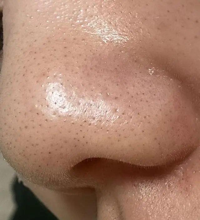 ** 앍!!! 솔직후기인데 왜 게시가 불가능하다고 뜰가요ㅠㅠ 2회차까지는 효과없다가 4회