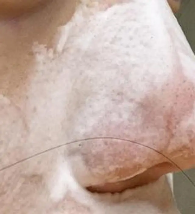 처음에 니프달을 알게 되었을땐 진짜 모공이 줄어들지 반신반의했었는데 하루하루 사용