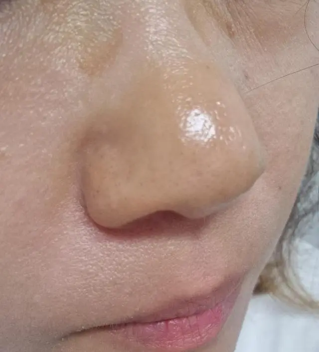 코팩빼고 눈에띄게 피지 없어진거 처음이예요ㅜㅜ
