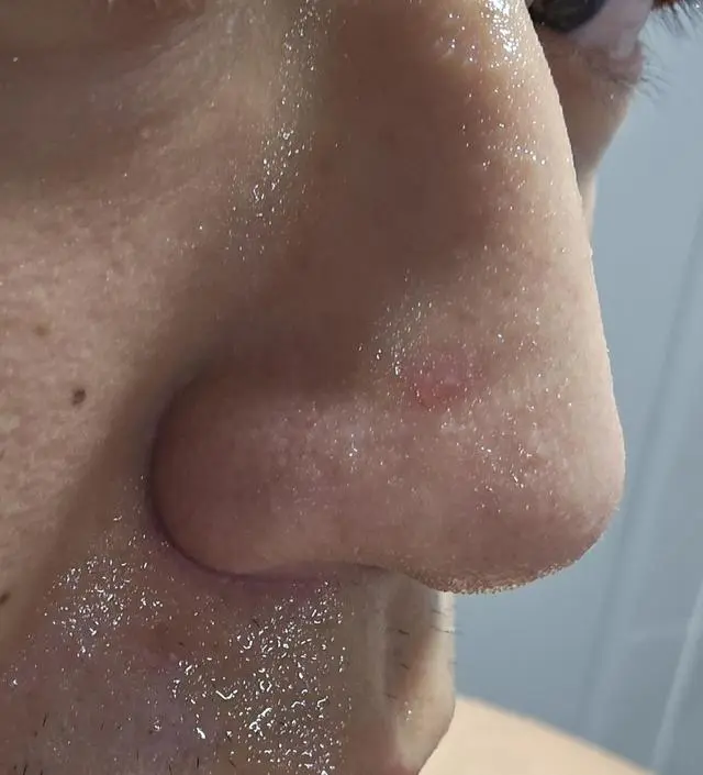 사용전에 비해 블랙헤드 제거가 너무나도 손쉽게 되었습니다. 세안만하였을때는 하루이