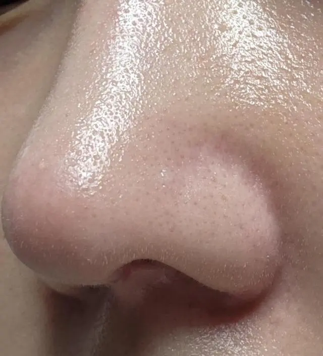 비염수술을 하고 코에 반창고를 오래 붙이고 있었더니 피부가 뒤집어졌었어요ㅜ 피부 관