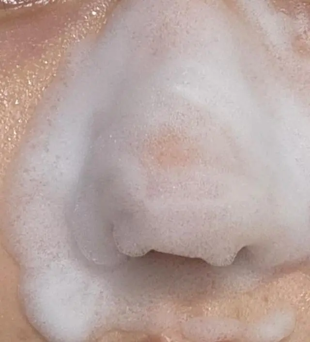 비염수술을 하고 코에 반창고를 오래 붙이고 있었더니 피부가 뒤집어졌었어요ㅜ 피부 관