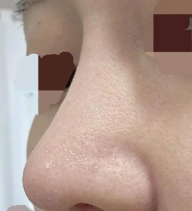 비염수술을 하고 코에 반창고를 오래 붙이고 있었더니 피부가 뒤집어졌었어요ㅜ 피부 관