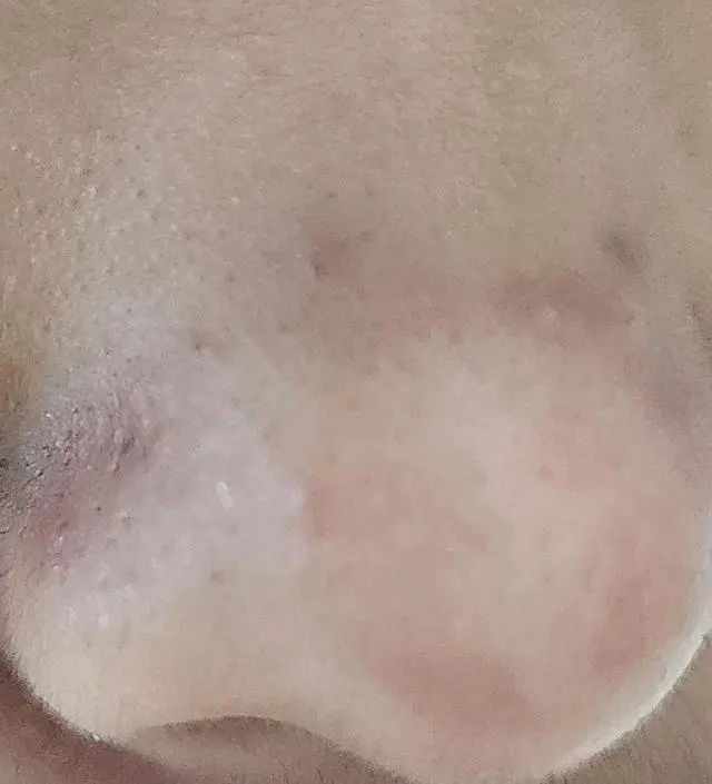 니프달을 사용한지 벌써 15일째 되었는데요 
