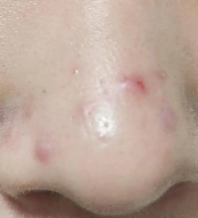 니프달을 사용한지 벌써 15일째 되었는데요 
