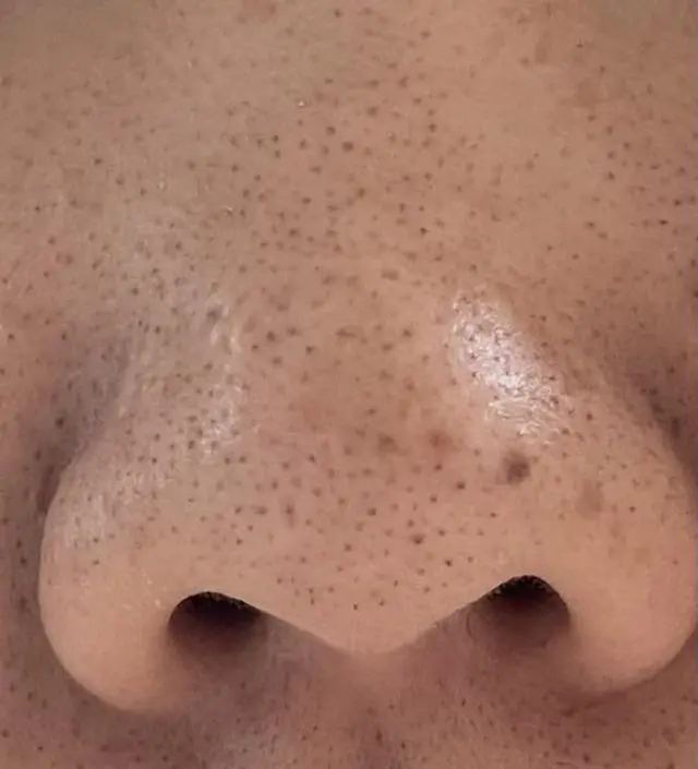 참고로 사진은 애프터 사진입니다,, 그냥 보기엔 블랙헤드가 그대로 있는 것처럼 보이지