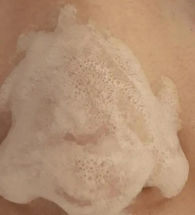 20일가량 니프달을 아침 저녁으로 사용해봤습니다. 더운 여름 땀과 유분으로 블랙헤드가