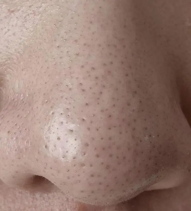 맨처음 클렌저를 알아볼때 반신반의하면서 고민고민하다 구입하게되었어요 모공도 크고