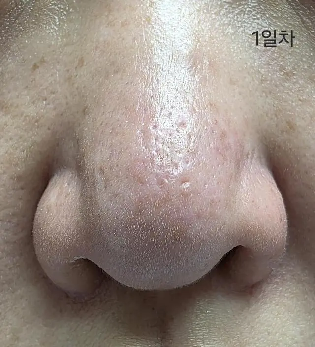 꾸준함이 중요한거같아요. 매일 하고, 올라오던 트러블 건드리지않고 같이 해주니 가라