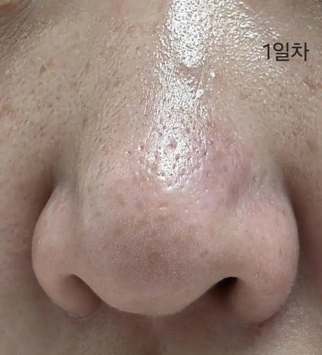 꾸준함이 중요한거같아요. 매일 하고, 올라오던 트러블 건드리지않고 같이 해주니 가라