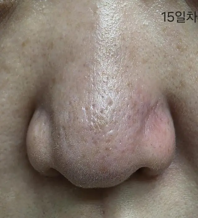 꾸준함이 중요한거같아요. 매일 하고, 올라오던 트러블 건드리지않고 같이 해주니 가라