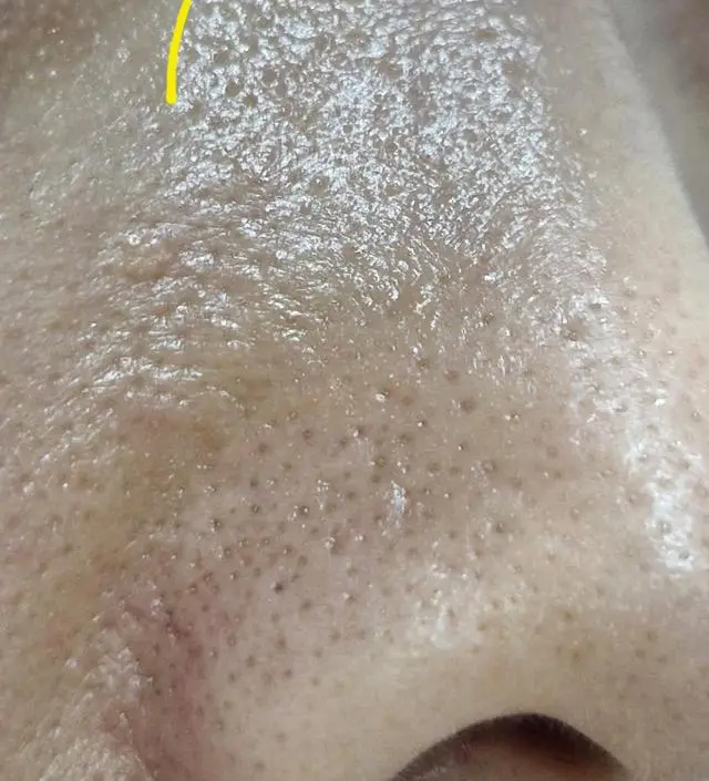 거울 볼때마다 블랙헤드 때문에 늘 고민이었는데 니프달을 사용하고 많이 좋아졌어요~1