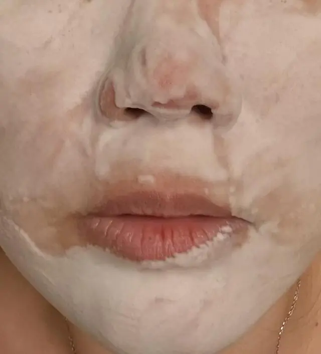 15일 동안 사용해본 니프달 후기입니다. 저는 일단 넓은 모공과 화이트헤드, 자잘한 좁