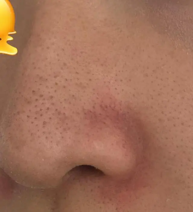 이번엔 제발 블랙헤드가 줄어들길 기원하면서 보름동안 열심히 사용했는데 처음엔 이게